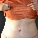 Tummy Tuck Before & After Patient #583