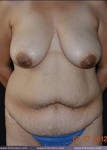 Mommy Makeover Before & After Patient #595