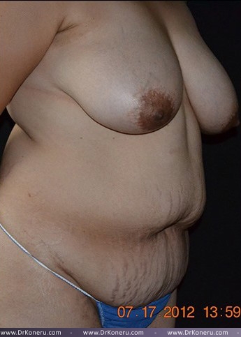 Mommy Makeover Before & After Patient #595