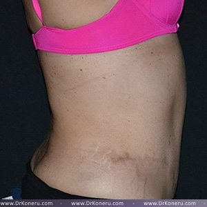 Tummy Tuck Before & After Patient #617