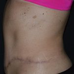 Tummy Tuck Before & After Patient #617