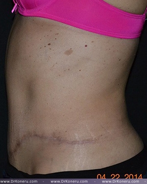 Tummy Tuck Before & After Patient #617