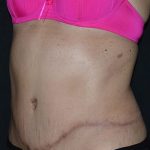 Tummy Tuck Before & After Patient #617