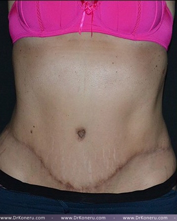Tummy Tuck Before & After Patient #617