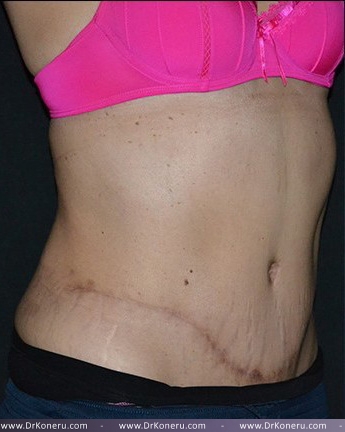 Tummy Tuck Before & After Patient #617