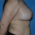 Breast Augmentation Before & After Patient #1003