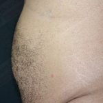 CoolSculpting Before & After Patient #1085