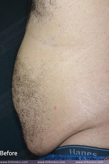 CoolSculpting Before & After Patient #1085