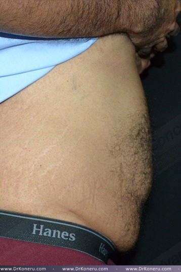CoolSculpting Before & After Patient #1085
