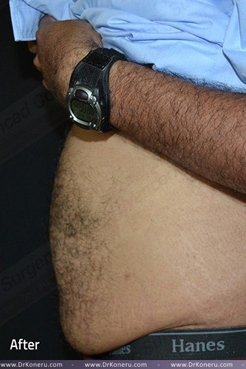 CoolSculpting Before & After Patient #1085