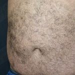 CoolSculpting Before & After Patient #1085