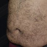 CoolSculpting Before & After Patient #1085