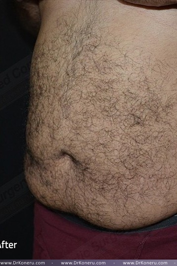 CoolSculpting Before & After Patient #1085
