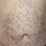 CoolSculpting Before & After Patient #1085