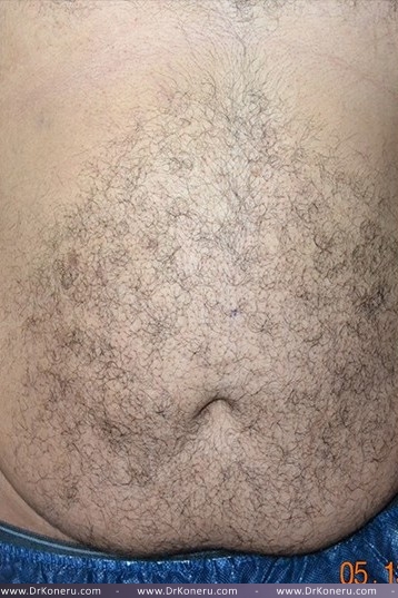 CoolSculpting Before & After Patient #1085