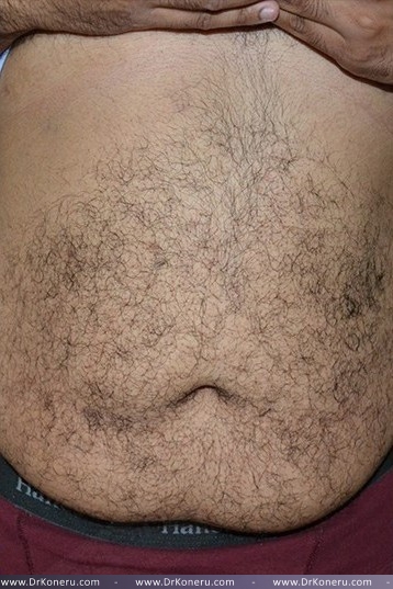 CoolSculpting Before & After Patient #1085