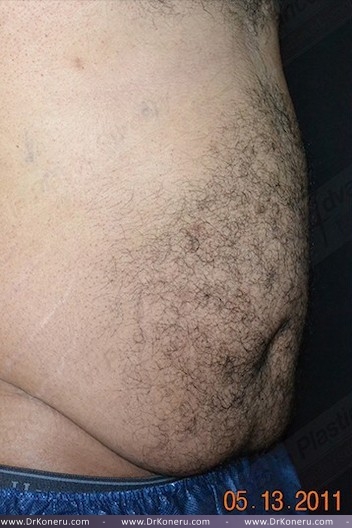CoolSculpting Before & After Patient #1085
