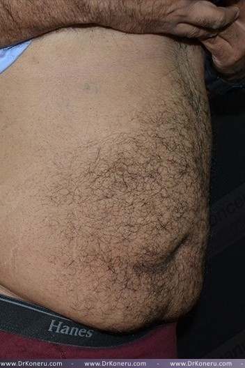 CoolSculpting Before & After Patient #1085