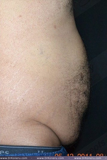 CoolSculpting Before & After Patient #1085