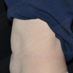 CoolSculpting Before & After Patient #1096