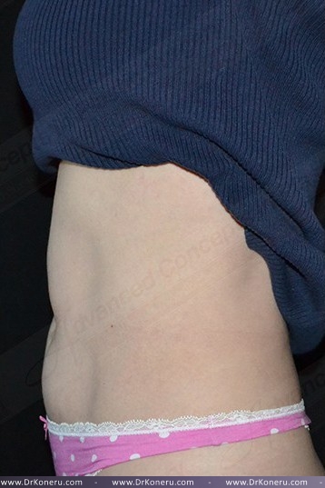 CoolSculpting Before & After Patient #1096
