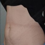 CoolSculpting Before & After Patient #1096