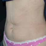 CoolSculpting Before & After Patient #1096