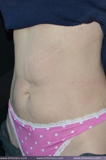 CoolSculpting Before & After Patient #1096