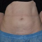 CoolSculpting Before & After Patient #1096