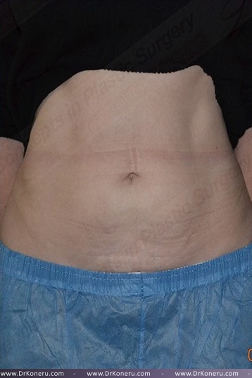 CoolSculpting Before & After Patient #1096