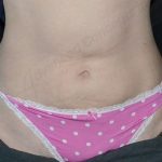 CoolSculpting Before & After Patient #1096