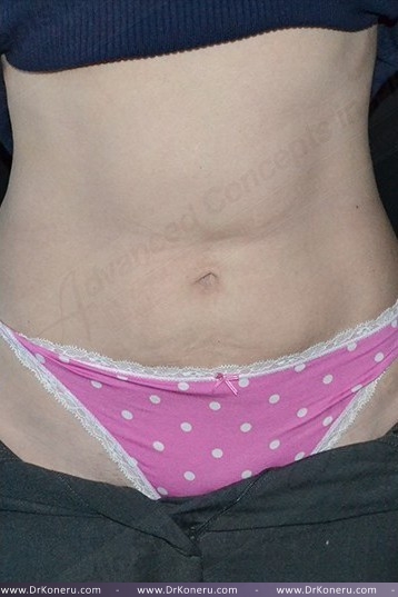 CoolSculpting Before & After Patient #1096