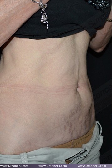 CoolSculpting Before & After Patient #1096