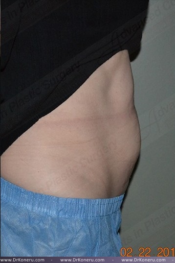CoolSculpting Before & After Patient #1096