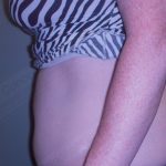 CoolSculpting Before & After Patient #1107