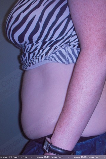 CoolSculpting Before & After Patient #1107