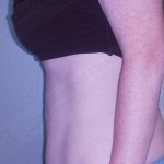 CoolSculpting Before & After Patient #1107