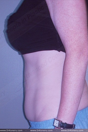 CoolSculpting Before & After Patient #1107