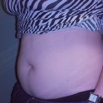 CoolSculpting Before & After Patient #1107