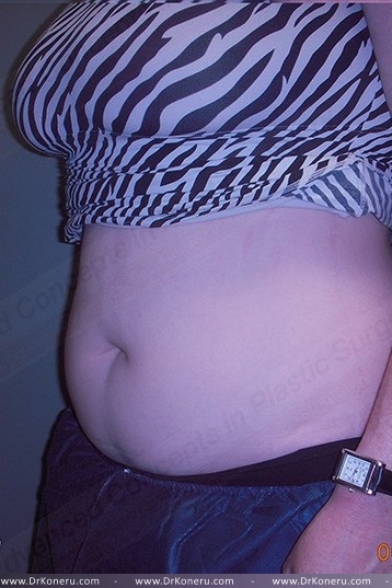 CoolSculpting Before & After Patient #1107