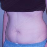 CoolSculpting Before & After Patient #1107