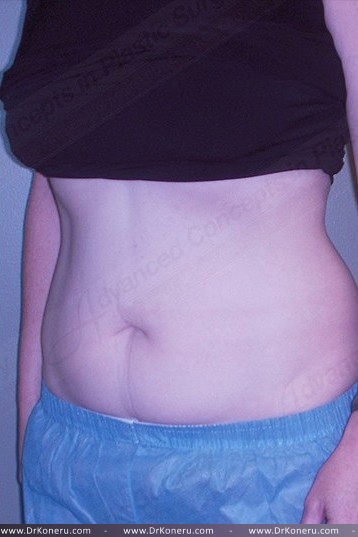CoolSculpting Before & After Patient #1107
