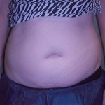 CoolSculpting Before & After Patient #1107