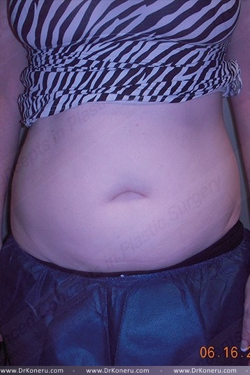 CoolSculpting Before & After Patient #1107