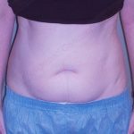 CoolSculpting Before & After Patient #1107