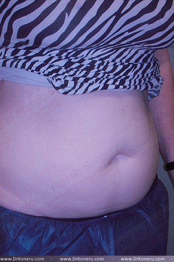 CoolSculpting Before & After Patient #1107