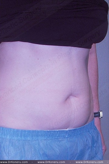 CoolSculpting Before & After Patient #1107