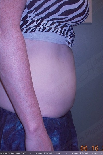 CoolSculpting Before & After Patient #1107