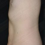 CoolSculpting Before & After Patient #1120
