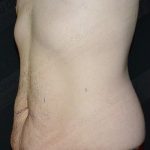 CoolSculpting Before & After Patient #1120